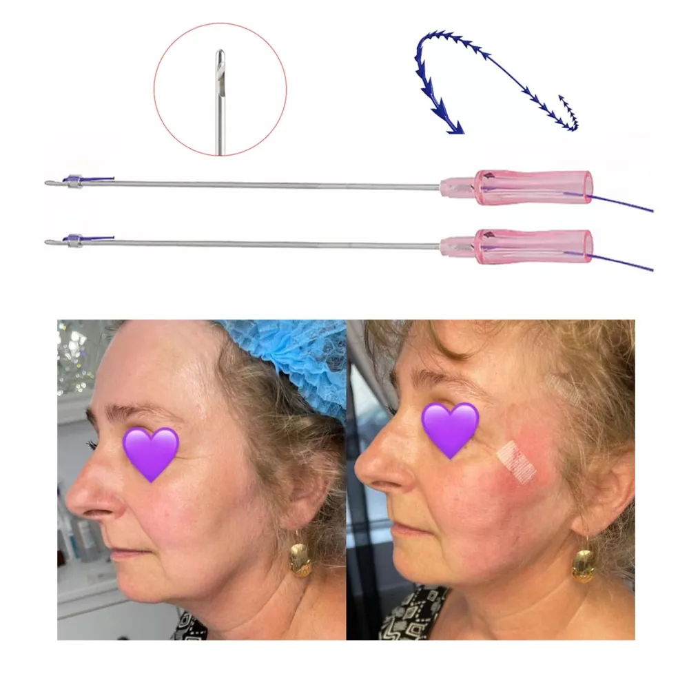 pdo cog lift thread (7) pdo cog lift thread (7)