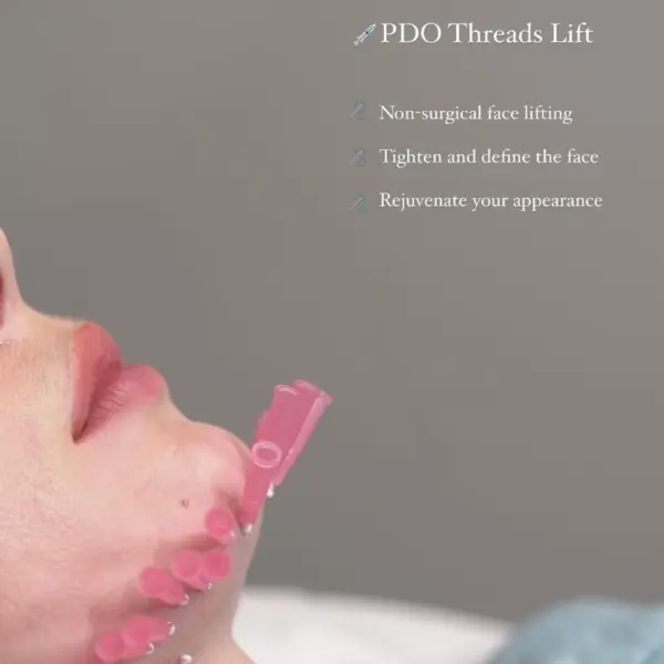 PDO-Screw Thread - Dreauty Filler